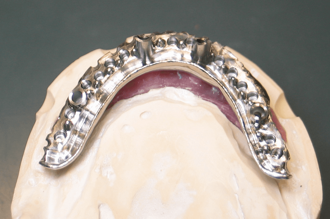 Hybrid with polished lingual and lingual finish line.