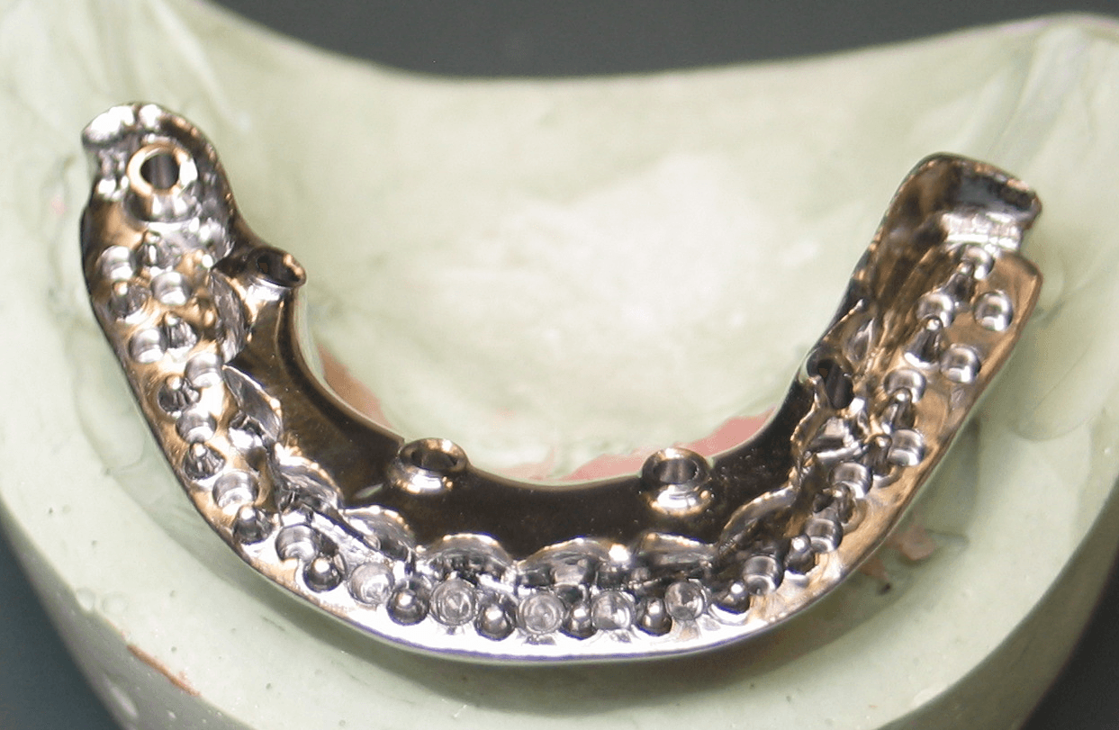  Polished lingual with individualized scalloping for each tooth. 