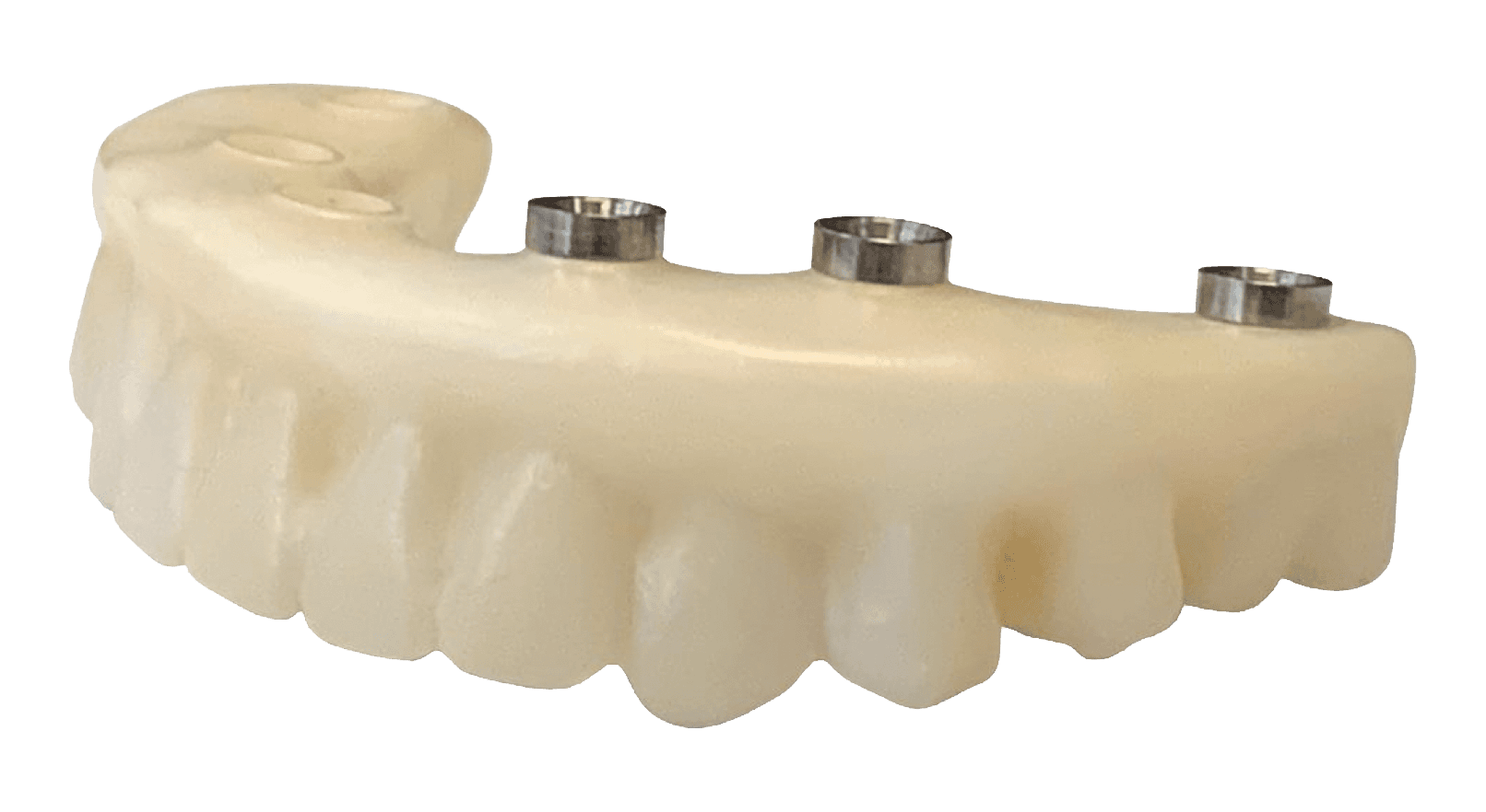 The dental technician then cements the physical implant connecting the component(s) into the physical dental restoration.